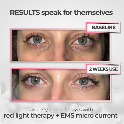 NuEye™ 2-in-1 Red Light + EMS Under-Eye Therapy