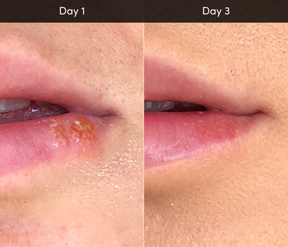 Nivo Red Light Lip Therapy Wand