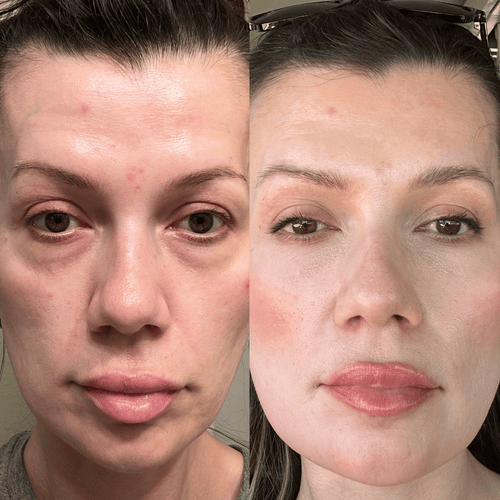 NuEye™ 2-in-1 Red Light + EMS Under-Eye Therapy